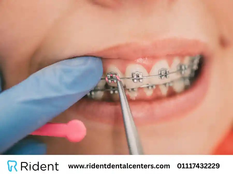 أفضل تقويم اسنان في 2025